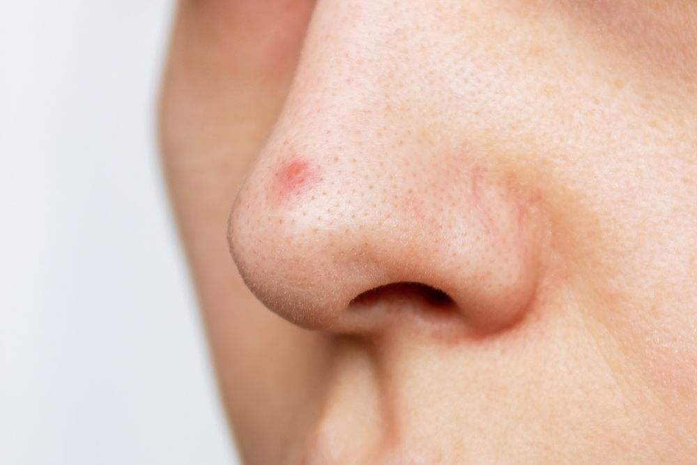 Nguyên nhân gây mụn bọc trên mũi